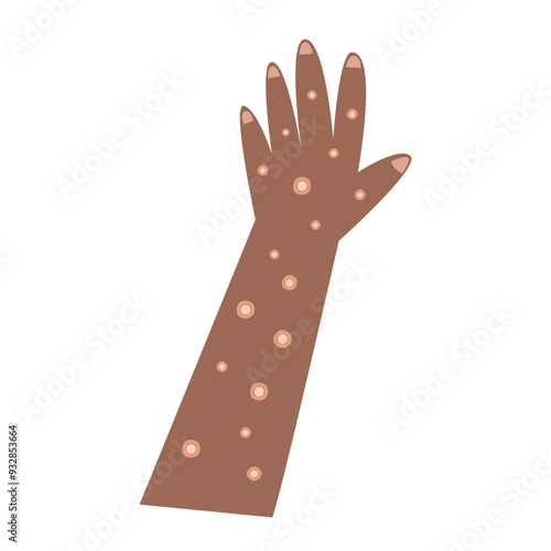 mpox, monkey pox disease. 