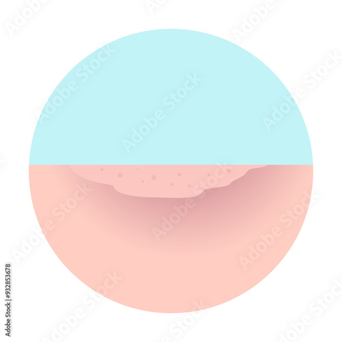 mpox, monkey pox disease. stage 6 healed of Mpox skin symptom