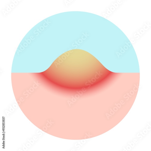 mpox, monkey pox disease. stage 4 pustule macule of Mpox skin symptom