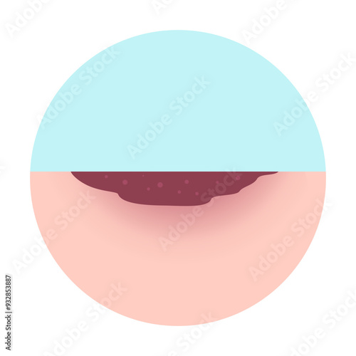 mpox, monkey pox disease. stage 5 crusting macule of Mpox skin symptom