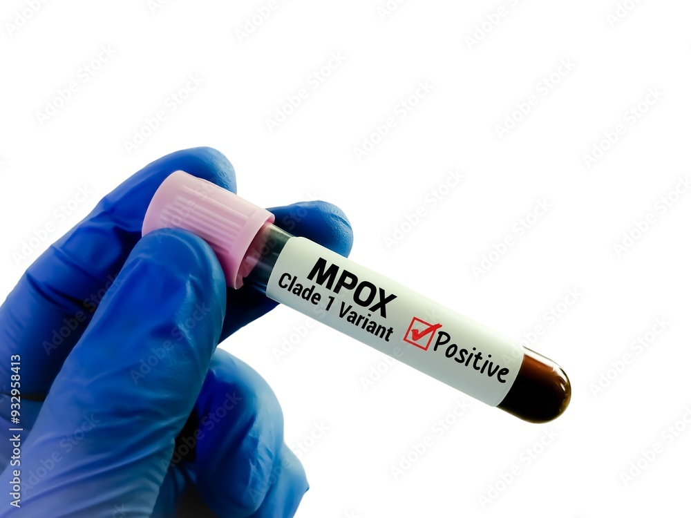 Obraz premium Blood sample for MPox (monkeypox) Clade 1 variant test.
