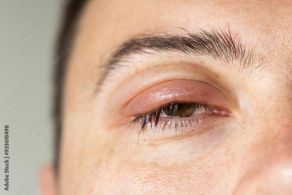 Fototapeta premium Swollen left eye with chalazion upper eyelid in the eye. concept disease eyelids manifests itself tumor. Benign formation rounded shape thickness eyelid. formed when meibomian gland duct is blocked