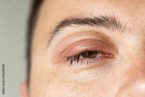 Swollen left eye with chalazion upper eyelid in the eye. concept disease eyelids manifests itself tumor. Benign formation rounded shape thickness eyelid. formed when meibomian gland duct is blocked