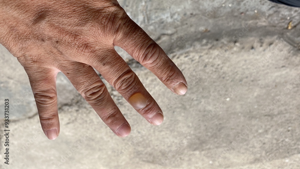 Fototapeta premium Blisters on the finger due to rubbing with hot water or being exposed to heat on the skin, risking infection. Burn Management