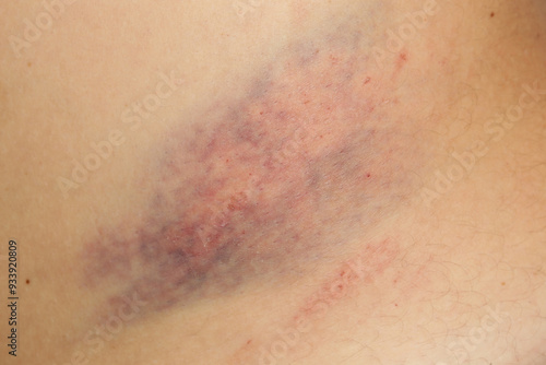 Close up view of a nasty bruise photo