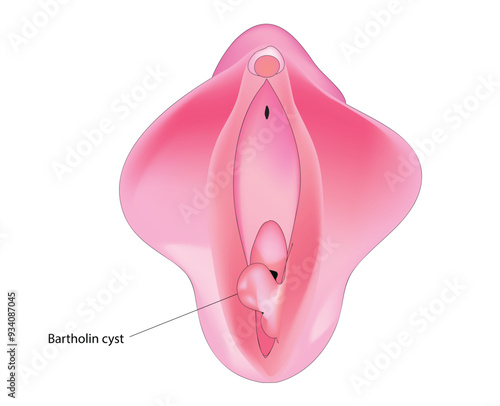 Bartholin's cyst