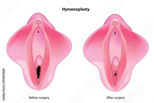 Hymenoplasty