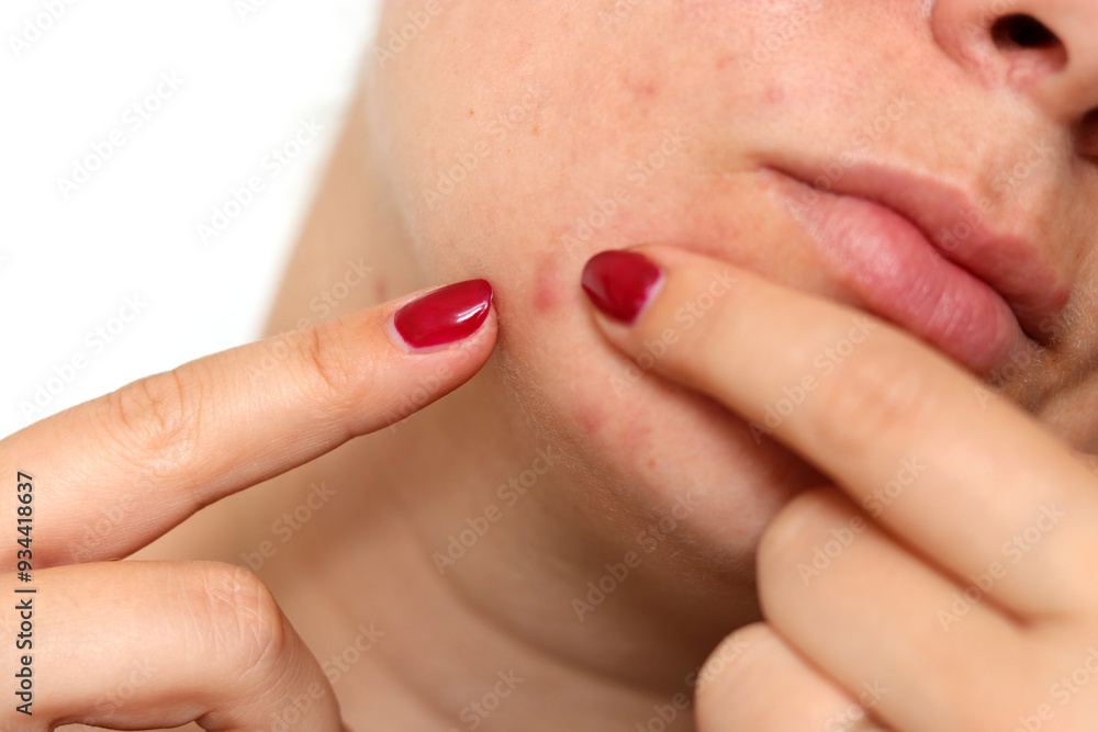 Obraz premium Close up of female face with red problematic acne skin and scars