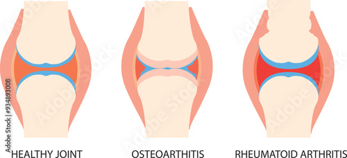 Joint anatomy, osteoarthritis and rheumatoid arthritis infographic with anatomical illustrations