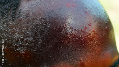 A close-up of a black male face showing the early stages of monkeypox, with red, raised lesions spreading across the cheeks and forehead, emphasizing the initial symptoms of the disease.