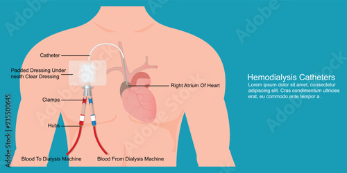 Hemodialysis catheters help clean blood when kidneys fail.