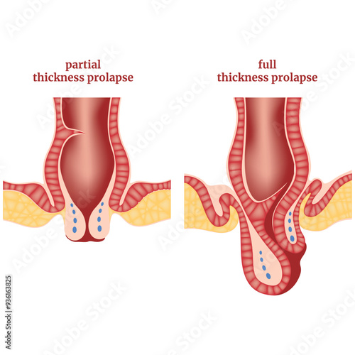 Anal prolapse, hemorrhoids. Diagram, scheme with the disease. Medical poster. Vector illustration