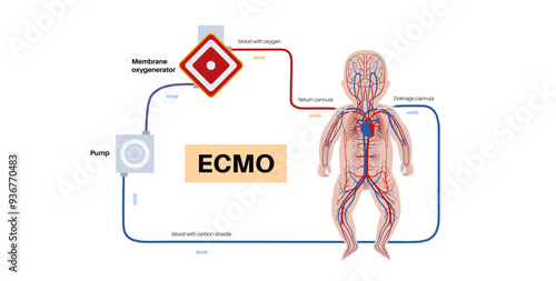 Extracorporeal membrane oxygenation