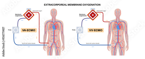 Extracorporeal membrane oxygenation