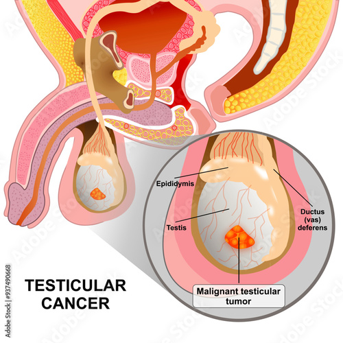 Malignant testicular cancer medical illustration