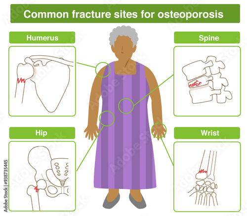 Whole body illustration of an elderly black woman with osteoporosis and common fracture sites for osteoporosis