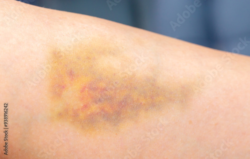 Bruises on the human body. Severe bruise from impact, bruising and hematoma. photo