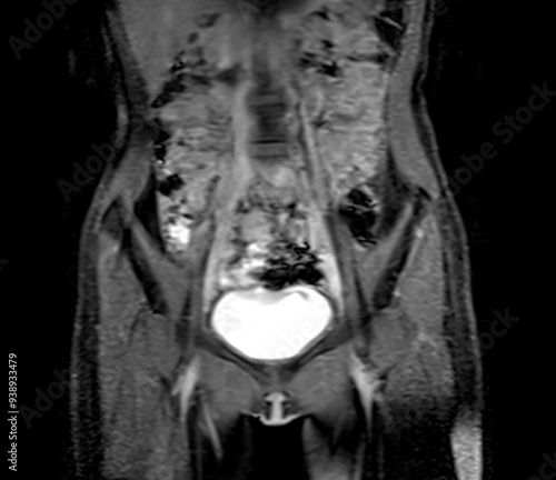 MRI abdomen coronal views are particularly useful for assessing liver, kidneys, and other abdominal organs with precision. photo