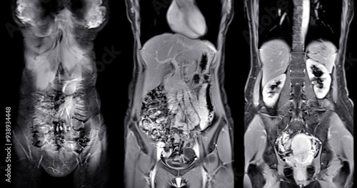 Foto MRI abdomen coronal views are particularly useful for assessing liver, kidneys, and other abdominal organs with precision