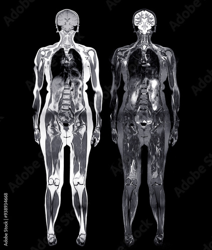 MRI whole body scans are beneficial for early cancer detection, monitoring chronic conditions, and overall health assessments.