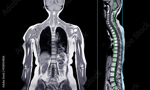 MRI whole body scans are beneficial for early cancer detection, monitoring chronic conditions, and overall health assessments.