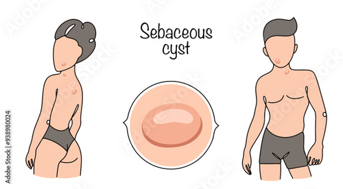 Sebaceous cyst