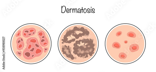 Dermatosis