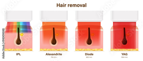 Hair removal vector. IPL, Alexandrite, Diode, YAG laser (Long Pulsed Nd Yag). Hair Remover Program.