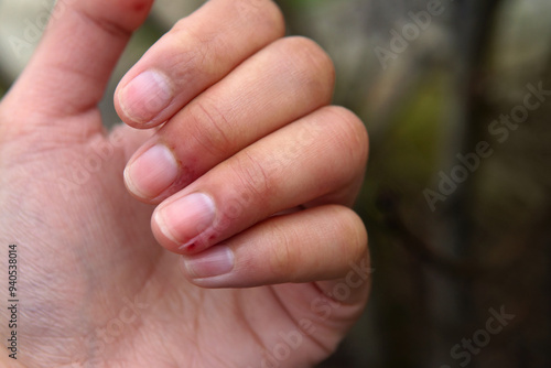 Close up Asian woman red infected hand with blood clot from coldness climate changes at winter while traveling oversea with forest green nature blurred background photo