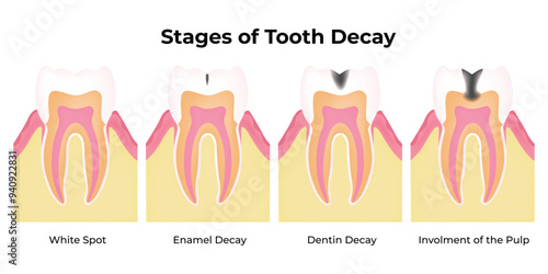 Stages of Tooth Decay Science Design Vector Illustration Diagram