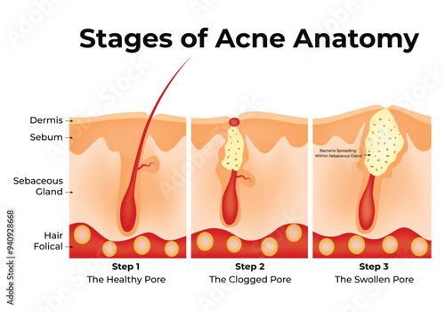 Stages of Acne Anatomy Science Design Vector Illustration Diagram