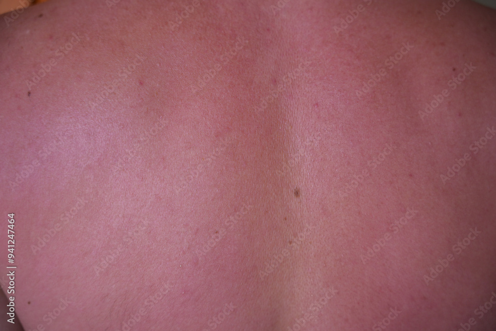sunburn on the skin of a man. swollen skin from blisters on the boy's shoulder. red skin he has an overabundance of sun. sunburn at a dangerous hour sunburn on the skin of a man. swollen skin from blisters on the boy's shoulder. red skin he has an overabundance of sun. sunburn at a dangerous hour