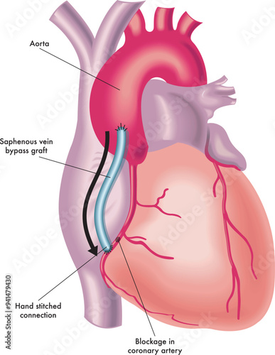 Medical illustration of a Coronary artery bypass grafting surgery, with annotations.