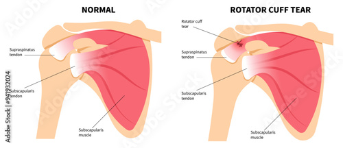 Shoulder muscle with Degenerative rotator cuff disease or sport injury