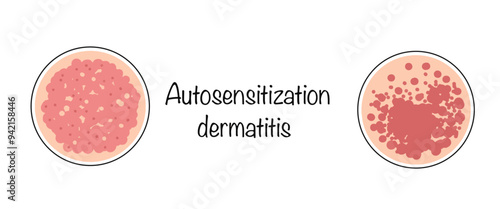 Autosensitization dermatitis