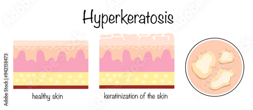 Hyperkeratosis