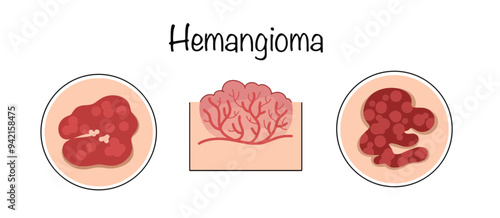 Hemangioma