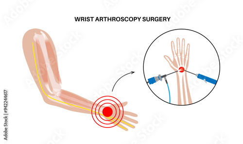 Wrist arthroscopy surgery