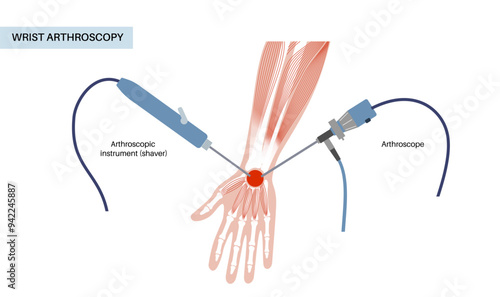 Wrist arthroscopy surgery