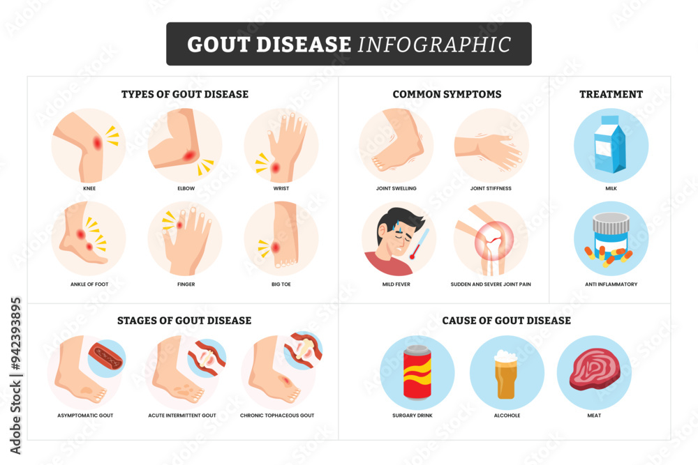 Gout disease infographic medical poster for education, labeled types of ...