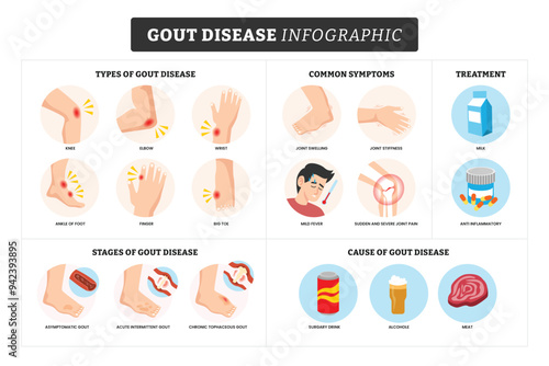 Gout disease infographic medical poster  for education, labeled types of gout disease, gout disease symptoms, stages of gout disease, treatment and cause with human anatomy.