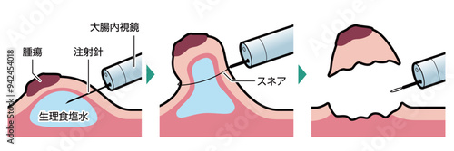 内視鏡的粘膜切除術（EMR）　図解