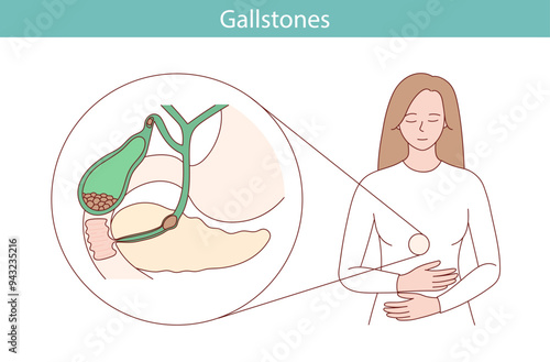 Schematic vector illustration of the structure of the gallbladder with stones.