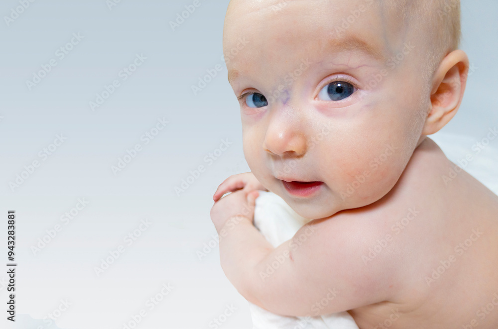 a baby with a hemangioma on his neck lies on a white background. banner with a copy space. profile of a little bald baby girl. the kid looks to the side