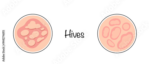 Hives