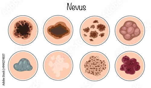 Nevus