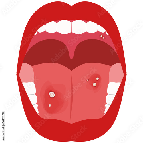 Mouth ulcer Illustration. Mouth disease.
