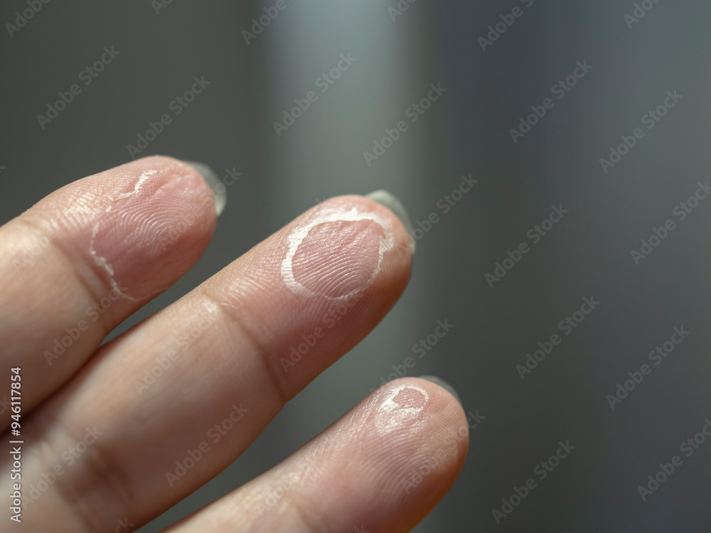 Peeling skin on fingertips is caused by many factors, such as environmental causes, underlying diseases, or underlying medical conditions. Peeling skin on fingertips is caused by many factors, such as environmental causes, underlying diseases, or underlying medical conditions.