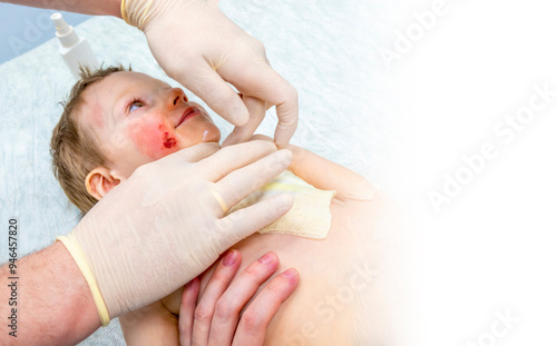 Obraz na płótnie medical procedure dressing a boy with a first-degree burn from boiling water on his face, neck and chest w salonie