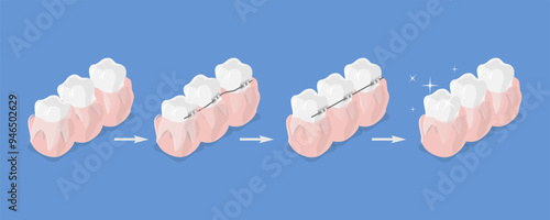 3D Isometric Flat Vector Illustration of Dental Teeth Braces, Orthodontic Care